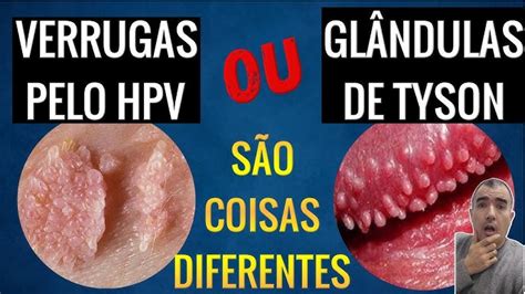 Glândulas de Tyson: o que são, porque aparecem e。